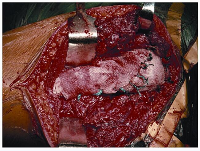 图36‐7 肱骨近端骨肉瘤病人,术中用mesh 重建肩关节囊