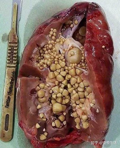 保护好肾,多喝水,远离肾结石[灵光一闪]