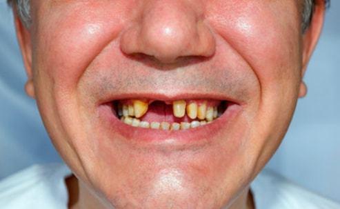 如何应对牙齿松动?中医:这四点需要知道!