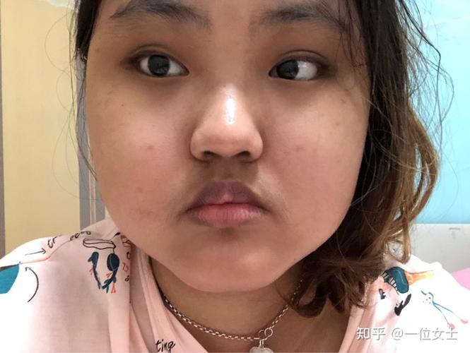 记录吃激素满月脸的恢复状况