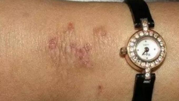 但是在生活中很多人对于金属都是过敏的,这是比较常见的一种过敏症状