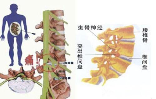 专家一一解答:腰椎间盘突出 都会造成腿疼吗?