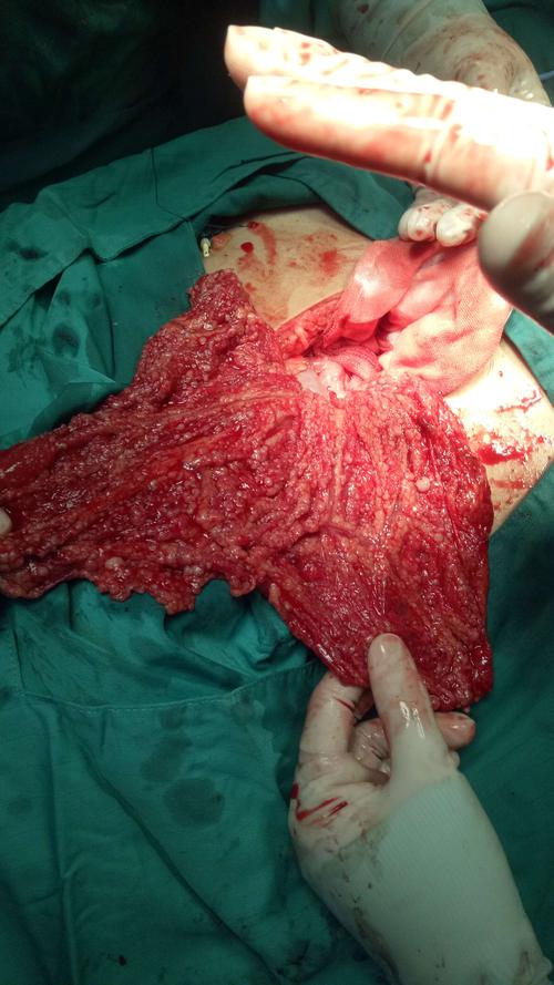 大网膜广泛粟粒样结节转移灶