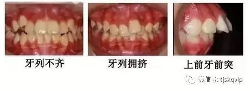 【口腔微学院】别让孩子张嘴睡觉,越睡越丑!