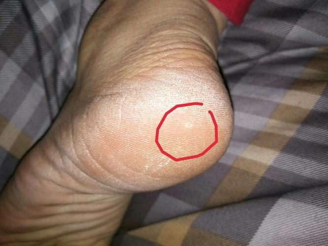 有人知道脚后跟长的这个白点点是啥吗?