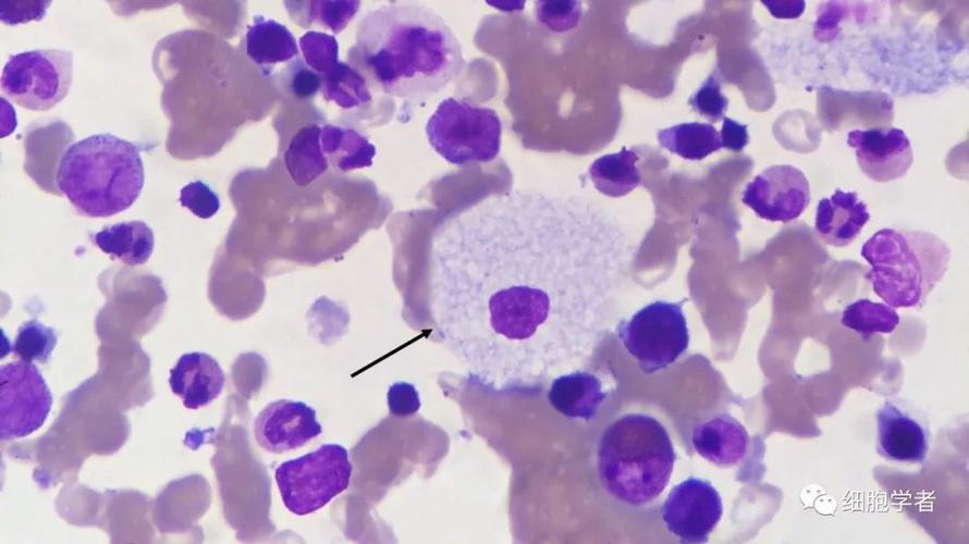 「吞噬细胞(噬血细胞)」   14   来源:骨髓-瑞氏染色       「成骨