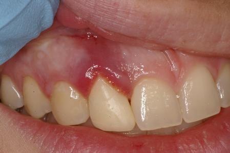 牙龈发炎肿痛,该怎么办?口腔医生和你聊聊