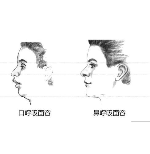 正美体态下巴后缩口呼吸口呼吸面容矫正