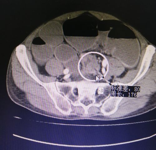 入院后立位腹平片如图所示:多发气液平面,提示肠梗阻!