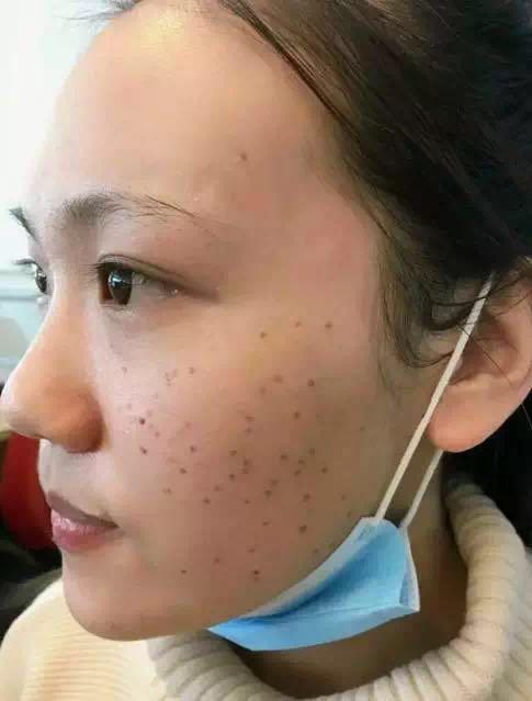 真人案例】下"斑"后的她,惊艳了所有人!