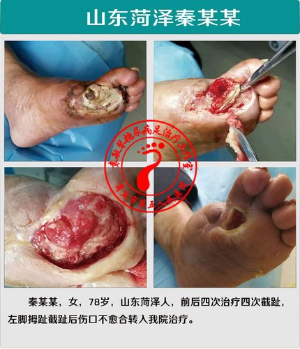 得了糖尿病足是不是很难医治