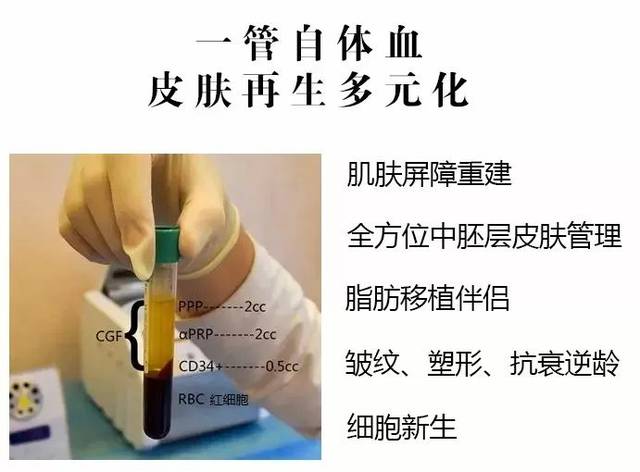藏在 cgf全方位抗衰疗法高浓缩自体生长因子是通过silfradent公司的mf