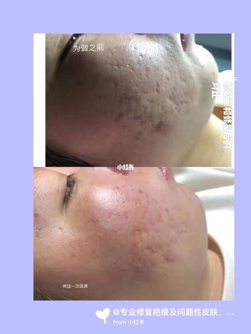 痘坑痘印修复前后对比_痘坑_修复痘印_痘痘_痘印痘坑