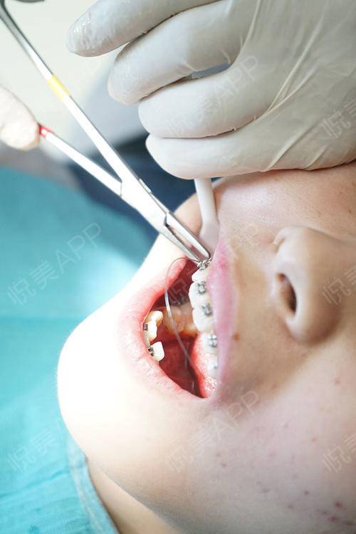 牙齿矫正手术当天_牙齿美容手术当天_小小丫丫分享图片8