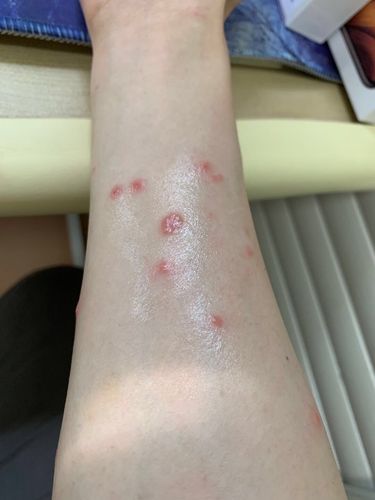 猫猫和人得了猫癣怎么办跪求急