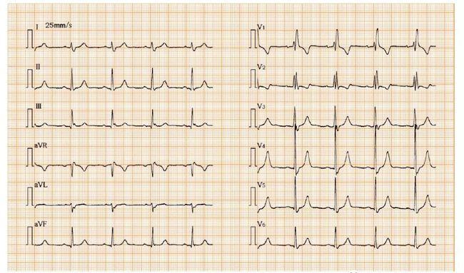 束支及分支传导阻滞的心电图特点