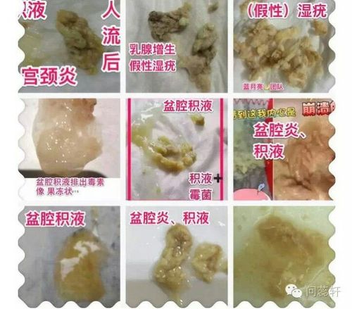 瘀血,病菌都轻松排出,而且还能对宫腔卵巢滋生的肌瘤,囊肿,息肉起到