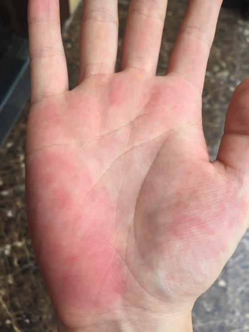 请问这个手掌发红是什么原因造成的?
