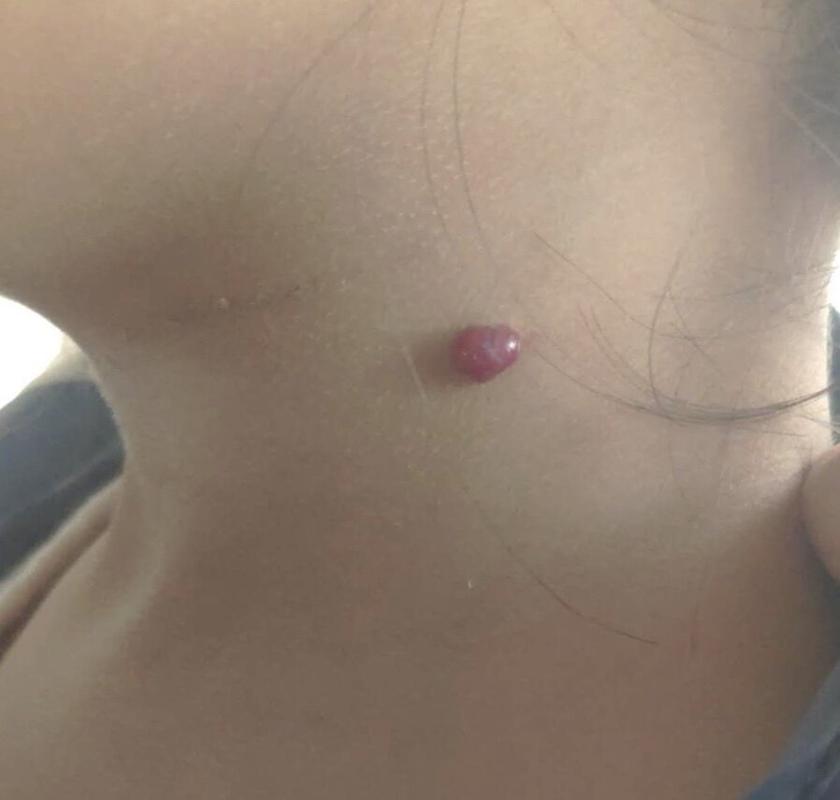 肉芽肿型血管瘤化脓性肉芽肿临床表现病因以及治疗