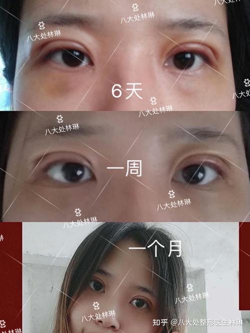 双侧全切重睑手术,平行型,重睑宽度7毫米,自然款,去皮一个月分享