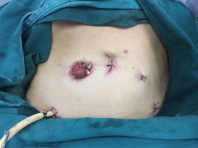 经腹经肛tatme,让极低位直肠癌保肛不再是梦想.