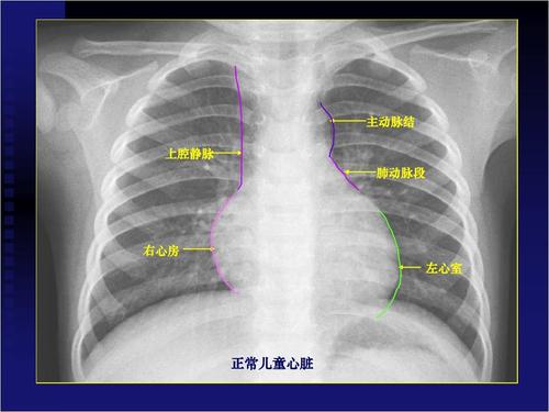 主动脉结 上腔静脉 肺动脉段 右心房 左心室 正常儿童心脏