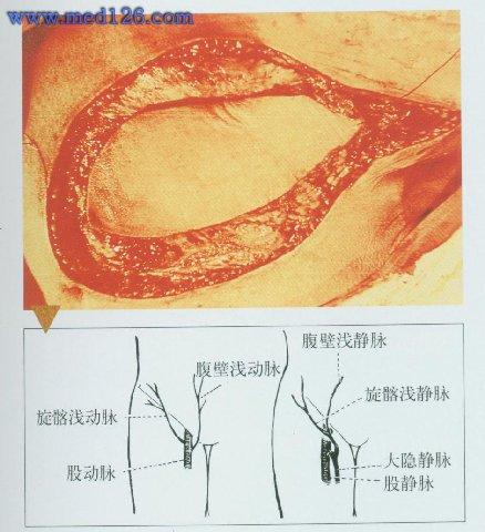 游离腹股沟皮瓣移植术    皮瓣设计:   点:腹股沟韧带下方2cm股动脉