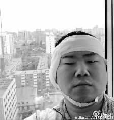 岳云鹏手术后纱布包头