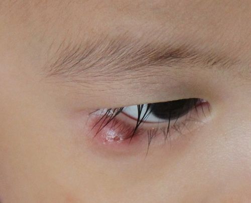 如何鉴别麦粒肿这种疾病呢