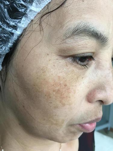 43岁女子淡化黄褐斑历时3个月从满脸斑到干净经验值得借鉴