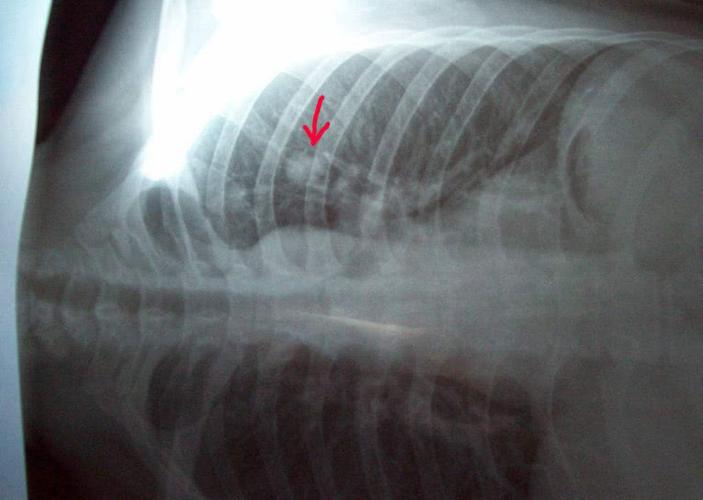 女人大都比较排斥胸透,做胸透时,医生会看到什么?看完