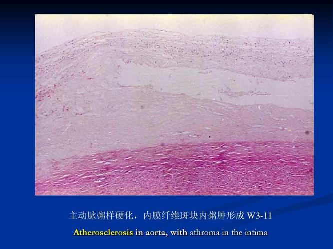 主动脉粥样硬化,内膜纤维斑块内粥肿形成 w3-11 atherosclerosis in