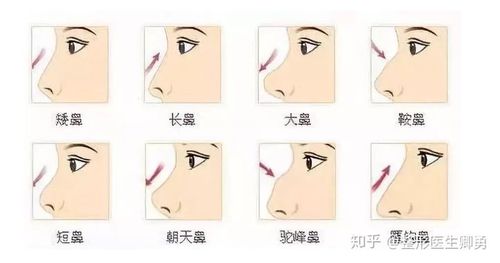 4,美观:朝天鼻矫正术后鼻梁线条流畅,自然美观.