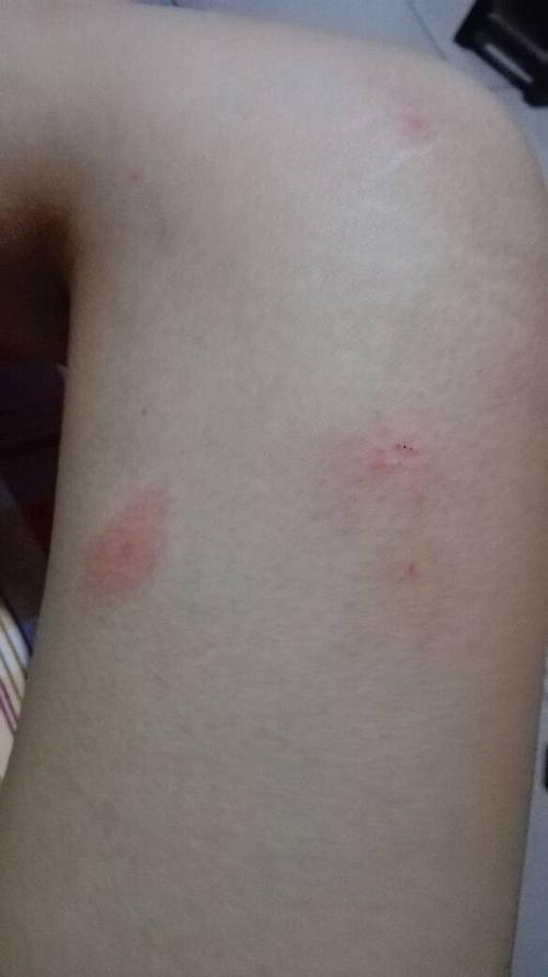 懂得人告诉我这是什么,外面红晕,里面是小红点,微痒