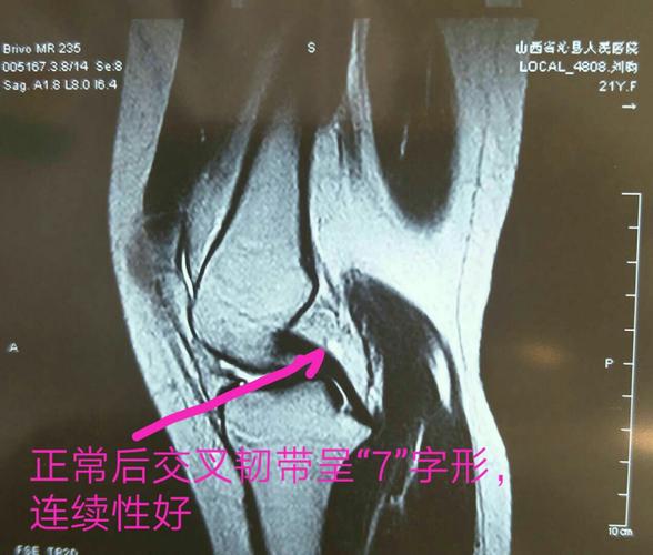 我院首例关节镜下行膝关节后交叉韧带损伤自体肌腱修复手术