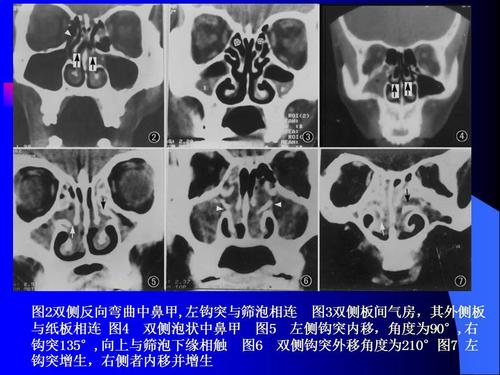 【ppt】副鼻窦和鼻咽腔的ct解剖