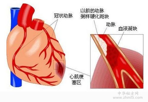 首页 心脑血管   心肌梗死是一种心肌出现的梗塞现象,长久下去会影响