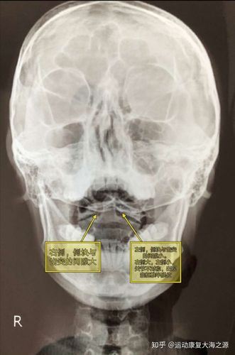 寰枢椎半脱位康复案例