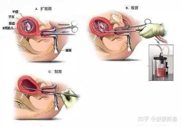 子宫负压吸引术,图源网络