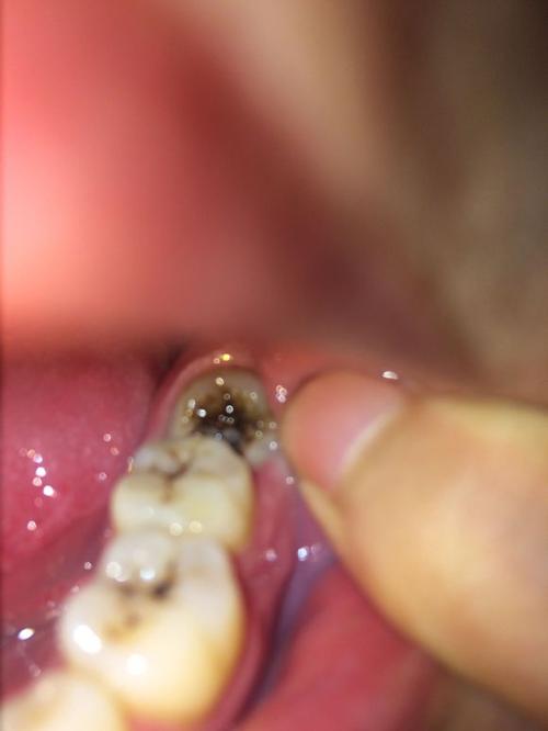 一颗小小智齿姿势千奇百怪,你的智齿长啥样?