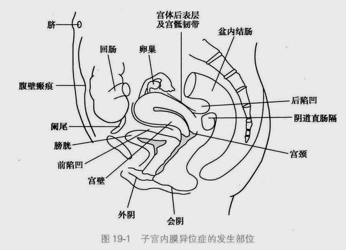 一,发生部位 卵巢,宫骶韧带最常见,腹腔镜检查是确诊盆腔内异症的标准