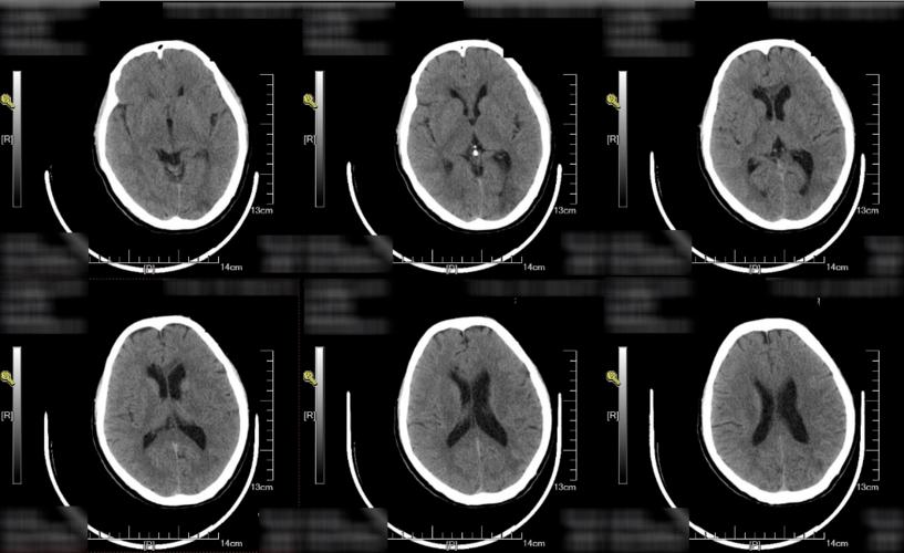 头颅ct提示多发腔隙性脑梗死.