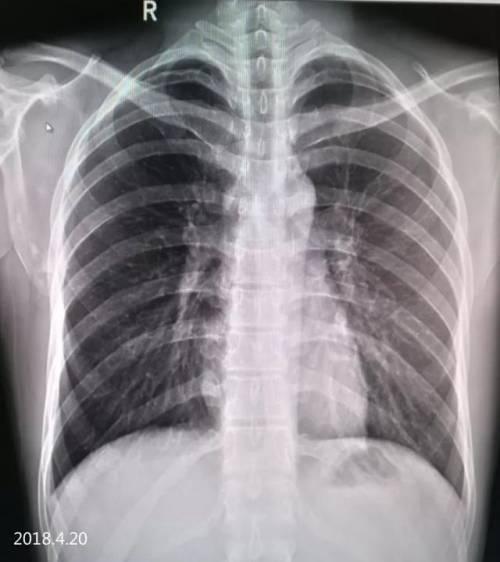 4.17 气胸复张,右下肺见液平面已吸收