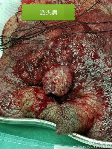 "蛋蛋"知识大全:阴囊痛/睾丸痛