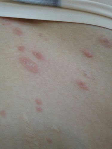 玫瑰糠疹还是梅毒 ? 非常痒