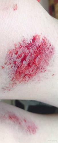 膝盖摔伤,抹了碘伏结痂后如何防止留疤?