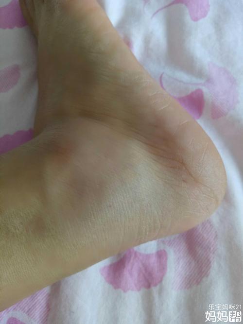 脚扭了,心也跟着凉了!