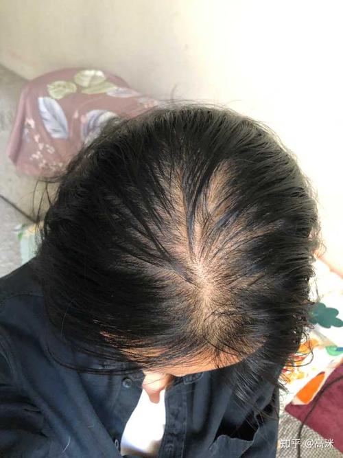 女生头顶头发少是什么体验