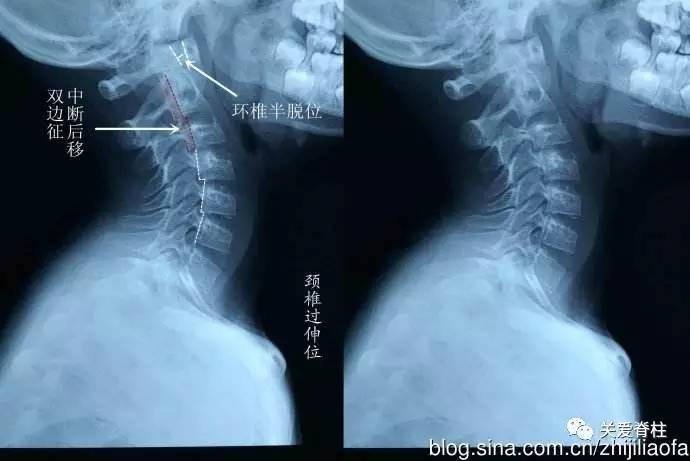 专家介绍说,"儿童颈椎病"的发病主要可以归纳为3个方面.