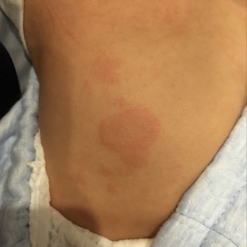 宝宝一岁多了,突然长红斑,越长越大,是怎么回事呢,精神也挺好